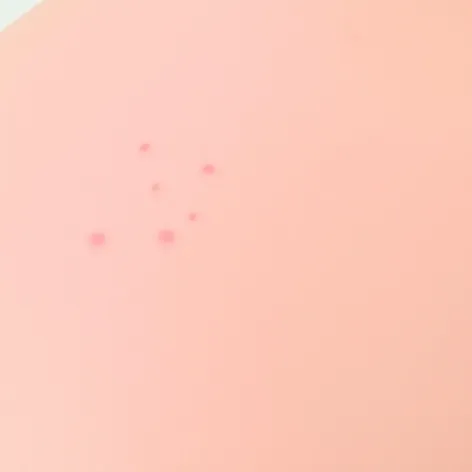 are benign birthmark moles