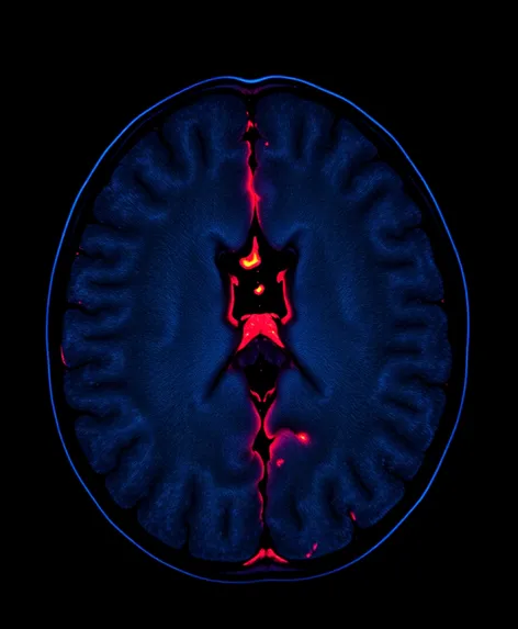 herniated disc in mri