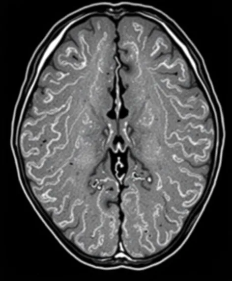 slipped disc mri